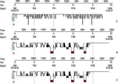 Sleep Disorders in Leucine-Rich Glioma-Inactivated Protein 1 and Contactin Protein-Like 2 Antibody-Associated Diseases